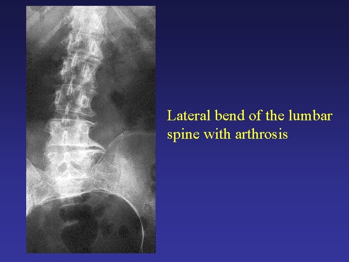 Lateral bend of the lumbar spine with arthrosis Lateral bend of the lumbar spine with arthrosis