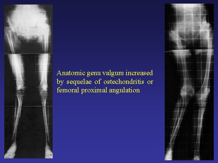 Anatomic genu valgum increased by sequelae of ostechondritis or femoral proximal angulation Anatomic genu valgum increased by sequelae of ostechondritis or femoral proximal angulation