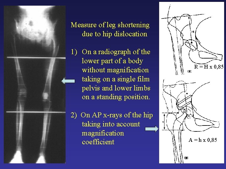 Measure of leg shortening due to hip dislocation 1) On a radiograph of the Measure of leg shortening due to hip dislocation 1) On a radiograph of the