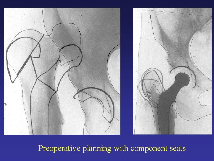 Preoperative planning with component seats Preoperative planning with component seats