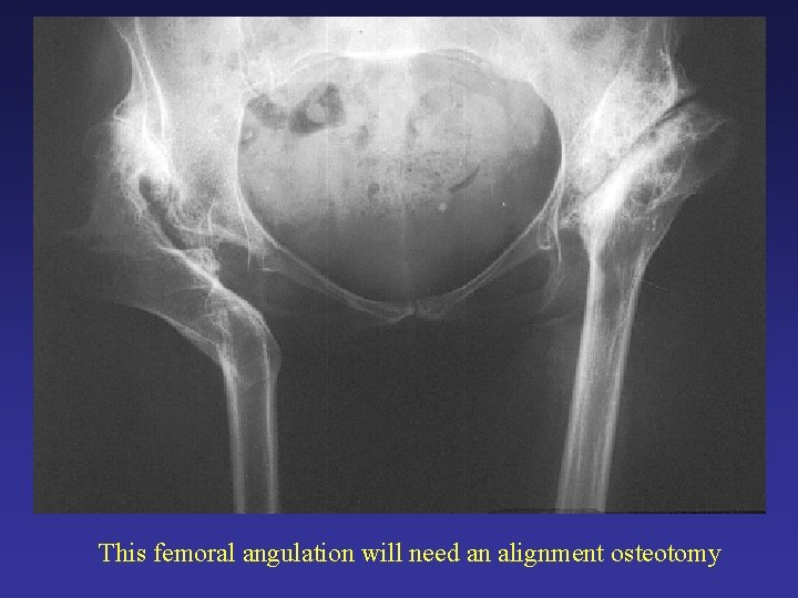 This femoral angulation will need an alignment osteotomy This femoral angulation will need an alignment osteotomy