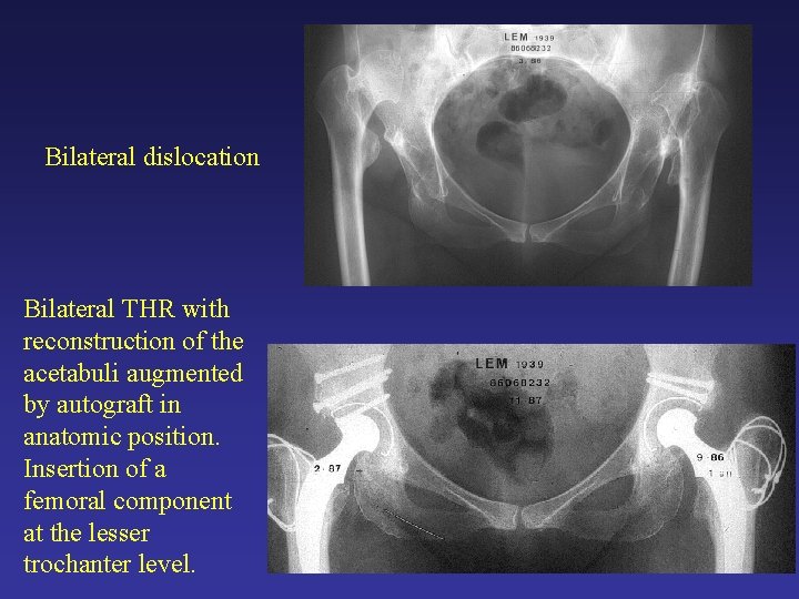 Bilateral dislocation Bilateral THR with reconstruction of the acetabuli augmented by autograft in anatomic Bilateral dislocation Bilateral THR with reconstruction of the acetabuli augmented by autograft in anatomic