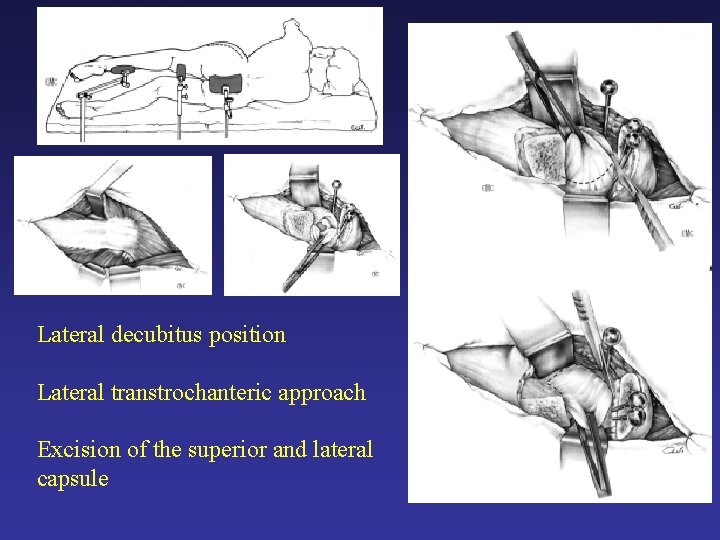 Lateral decubitus position Lateral transtrochanteric approach Excision of the superior and lateral capsule Lateral decubitus position Lateral transtrochanteric approach Excision of the superior and lateral capsule