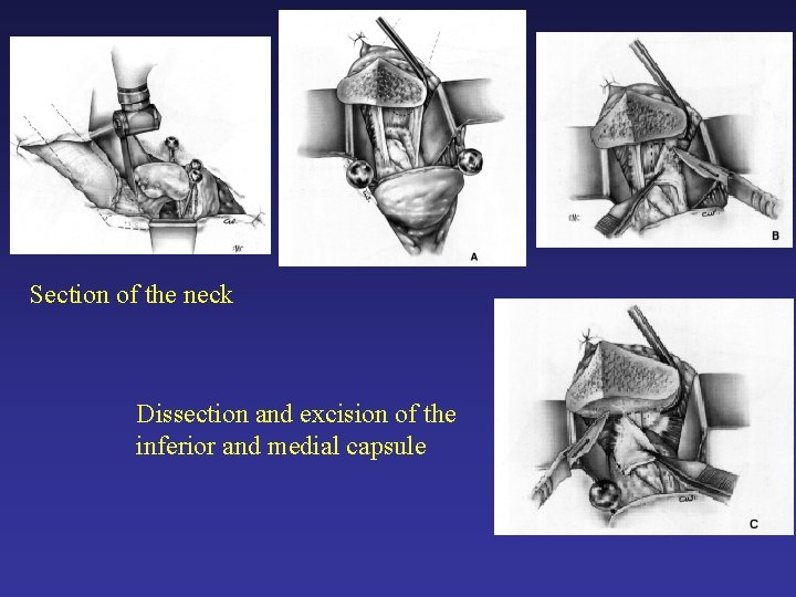 Section of the neck Dissection and excision of the inferior and medial capsule Section of the neck Dissection and excision of the inferior and medial capsule