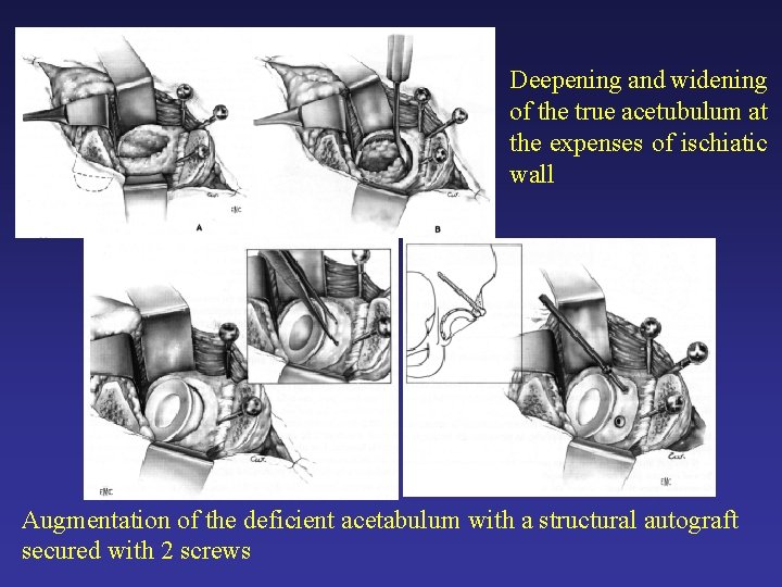 Deepening and widening of the true acetubulum at the expenses of ischiatic wall Augmentation Deepening and widening of the true acetubulum at the expenses of ischiatic wall Augmentation