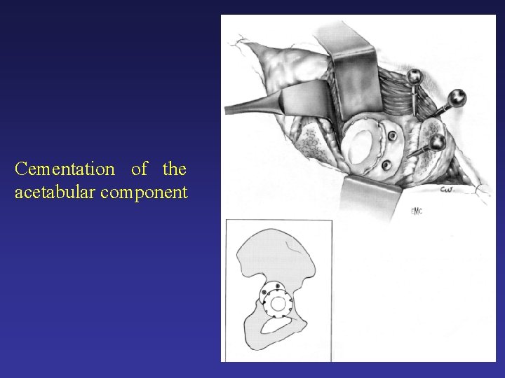 Cementation of the acetabular component Cementation of the acetabular component