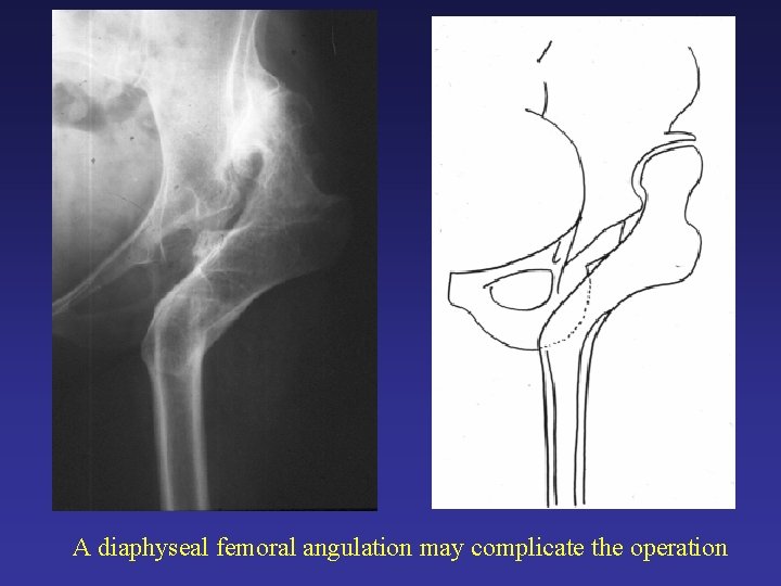 A diaphyseal femoral angulation may complicate the operation A diaphyseal femoral angulation may complicate the operation