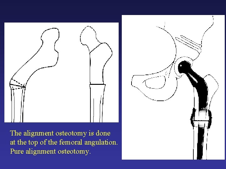 The alignment osteotomy is done at the top of the femoral angulation. Pure alignment The alignment osteotomy is done at the top of the femoral angulation. Pure alignment
