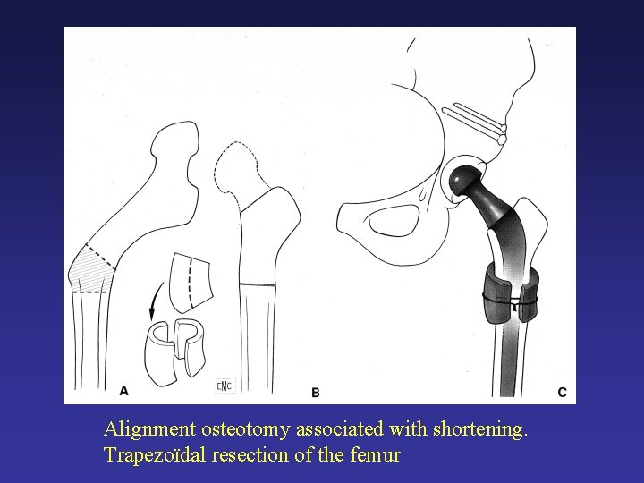 Alignment osteotomy associated with shortening. Trapezoïdal resection of the femur Alignment osteotomy associated with shortening. Trapezoïdal resection of the femur