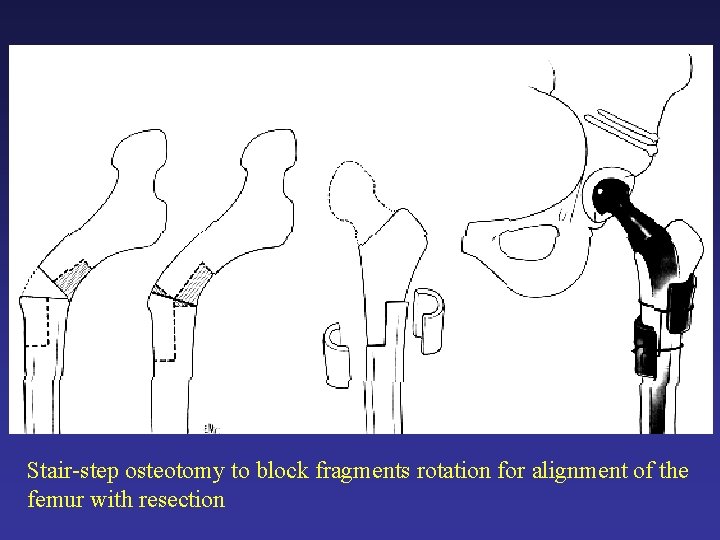 Stair-step osteotomy to block fragments rotation for alignment of the femur with resection Stair-step osteotomy to block fragments rotation for alignment of the femur with resection
