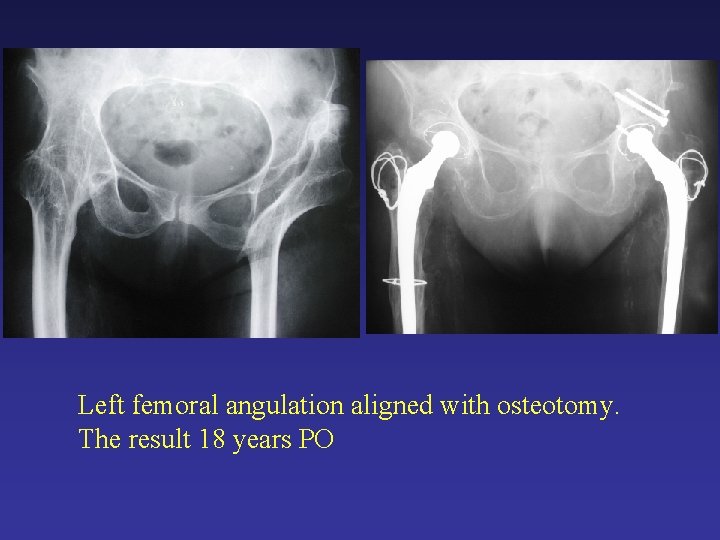 Left femoral angulation aligned with osteotomy. The result 18 years PO Left femoral angulation aligned with osteotomy. The result 18 years PO