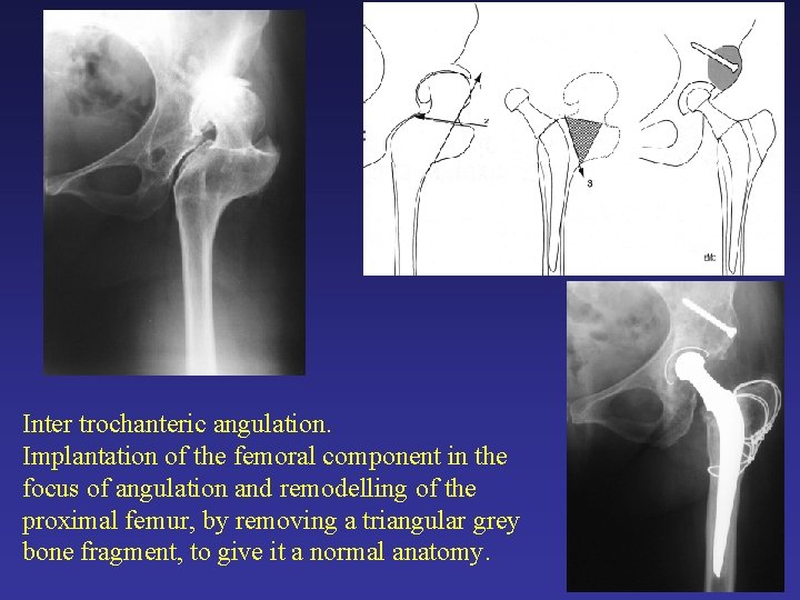 Inter trochanteric angulation. Implantation of the femoral component in the focus of angulation and Inter trochanteric angulation. Implantation of the femoral component in the focus of angulation and