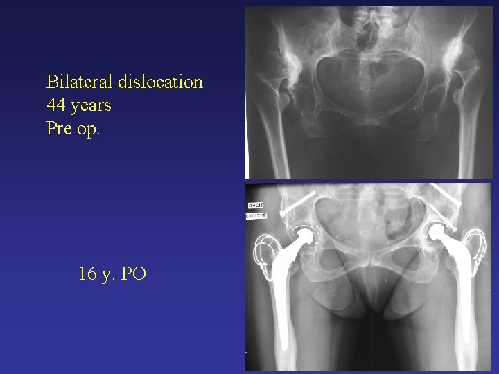 Bilateral dislocation 44 years Pre op. 16 y. PO Bilateral dislocation 44 years Pre op. 16 y. PO