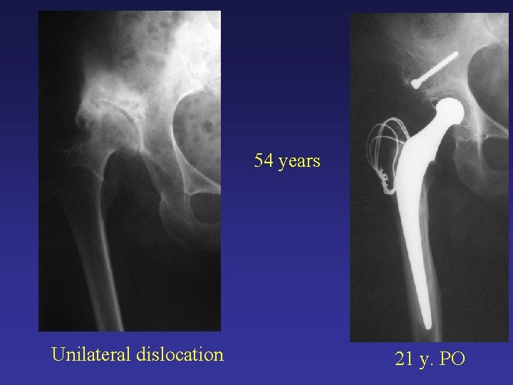 54 years Unilateral dislocation 21 y. PO 54 years Unilateral dislocation 21 y. PO