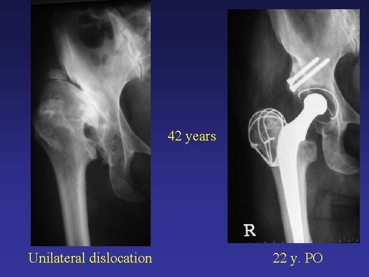 42 years Unilateral dislocation 22 y. PO 42 years Unilateral dislocation 22 y. PO