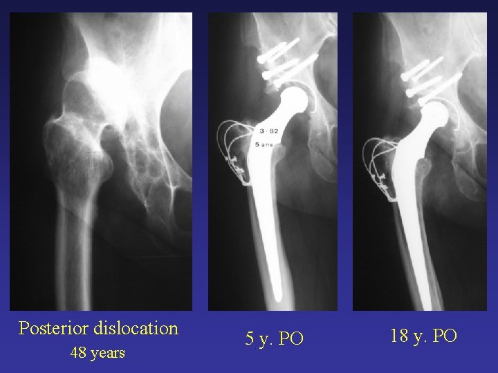 Posterior dislocation 48 years 5 y. PO 18 y. PO Posterior dislocation 48 years 5 y. PO 18 y. PO