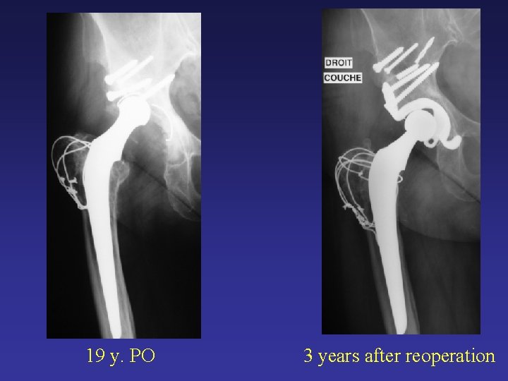 19 y. PO 3 years after reoperation 19 y. PO 3 years after reoperation