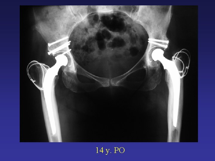 14 y. PO 14 y. PO