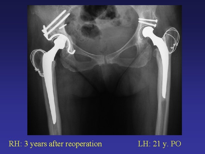RH: 3 years after reoperation LH: 21 y. PO RH: 3 years after reoperation LH: 21 y. PO