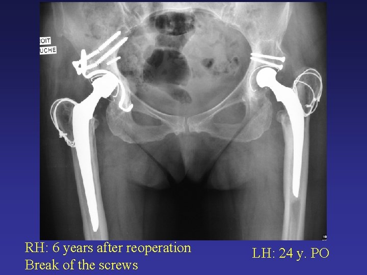 RH: 6 years after reoperation Break of the screws LH: 24 y. PO RH: 6 years after reoperation Break of the screws LH: 24 y. PO