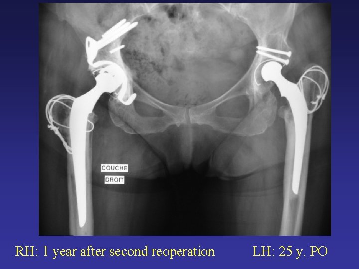 RH: 1 year after second reoperation LH: 25 y. PO RH: 1 year after second reoperation LH: 25 y. PO
