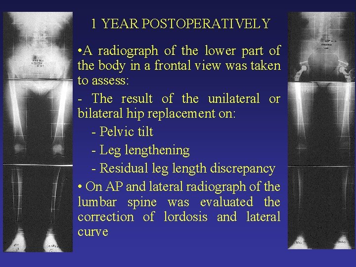 1 YEAR POSTOPERATIVELY • A radiograph of the lower part of the body in 1 YEAR POSTOPERATIVELY • A radiograph of the lower part of the body in