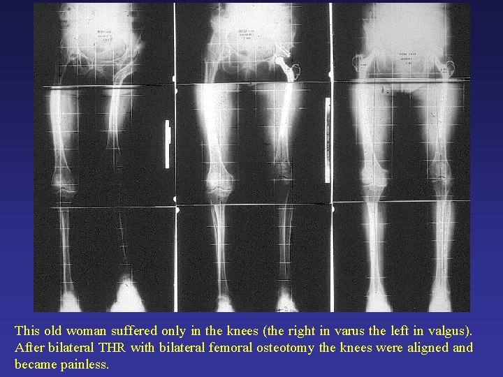 This old woman suffered only in the knees (the right in varus the left This old woman suffered only in the knees (the right in varus the left