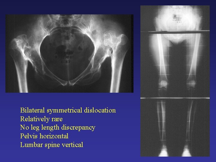 Bilateral symmetrical dislocation Relatively rare No leg length discrepancy Pelvis horizontal Lumbar spine vertical Bilateral symmetrical dislocation Relatively rare No leg length discrepancy Pelvis horizontal Lumbar spine vertical