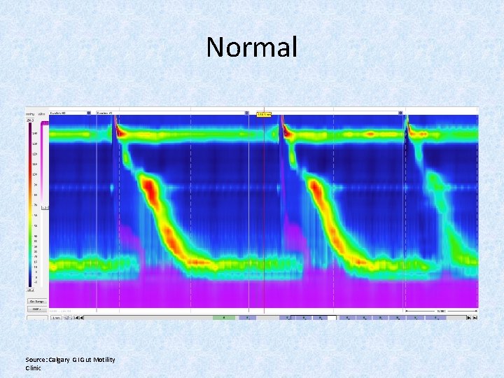 Normal Source: Calgary GI Gut Motility Clinic 