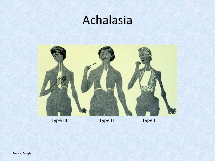 Achalasia Type III Source: Google Type II Type I 