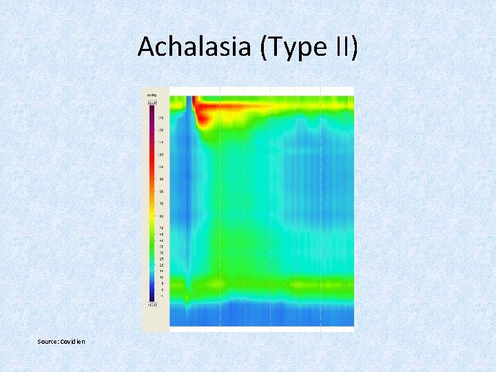 Achalasia (Type II) Source: Covidien 