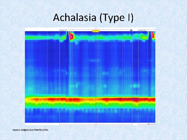 Achalasia (Type I) Source: Calgary Gut Motility Clinic 