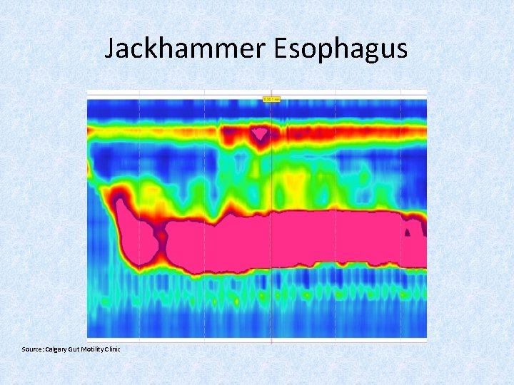 Jackhammer Esophagus Source: Calgary Gut Motility Clinic 