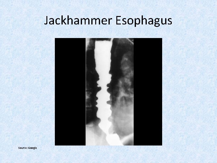 Jackhammer Esophagus Source: Google 