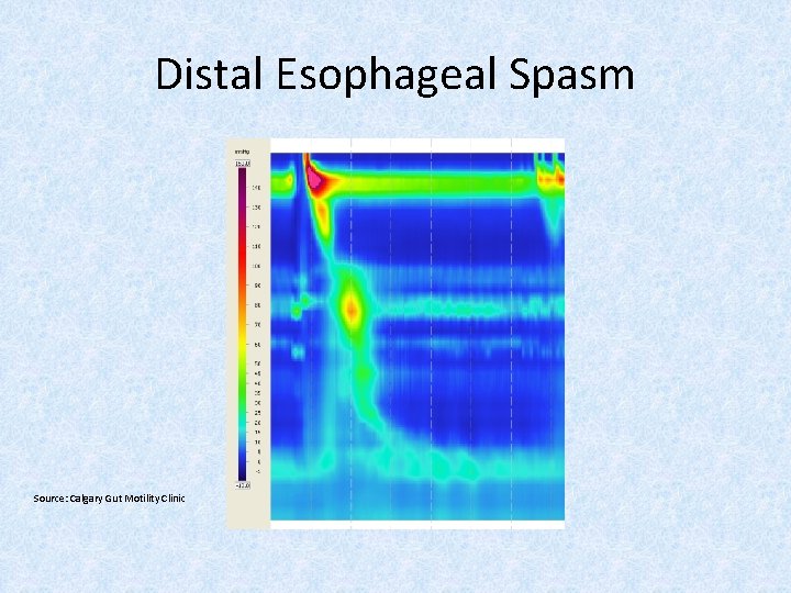 Distal Esophageal Spasm Source: Calgary Gut Motility Clinic 
