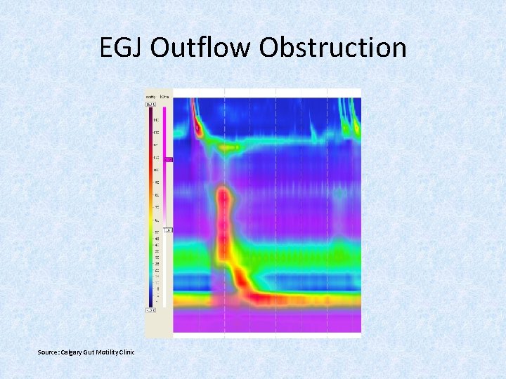 EGJ Outflow Obstruction Source: Calgary Gut Motility Clinic 