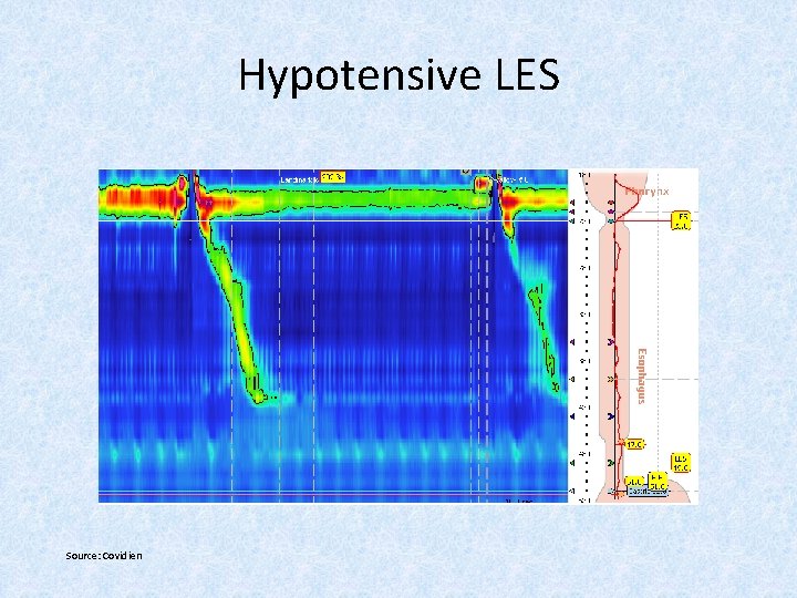 Hypotensive LES Source: Covidien 