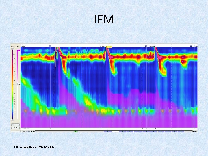 IEM Source: Calgary Gut Motility Clinic 