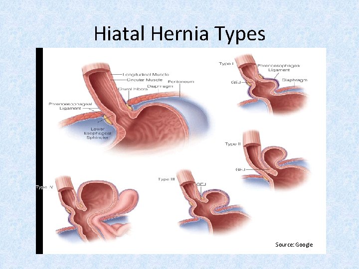 Hiatal Hernia Types Source: Google 