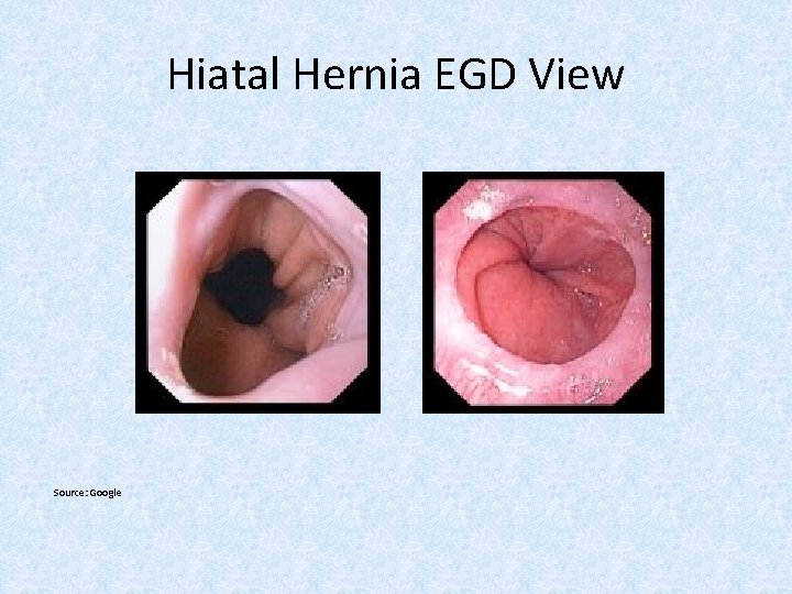 Hiatal Hernia EGD View Source: Google 