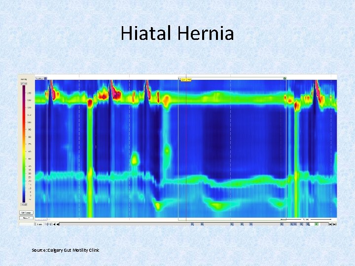 Hiatal Hernia Source: Calgary Gut Motility Clinic 