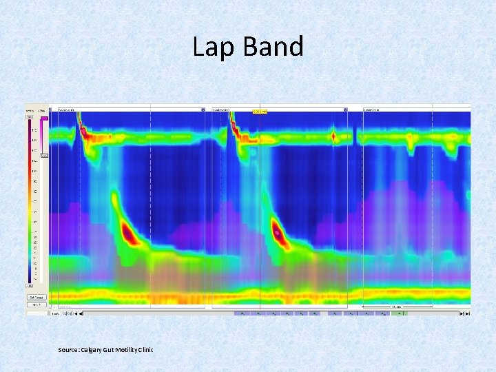 Lap Band Source: Calgary Gut Motility Clinic 