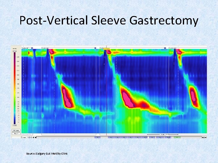 Post-Vertical Sleeve Gastrectomy Source: Calgary Gut Motility Clinic 
