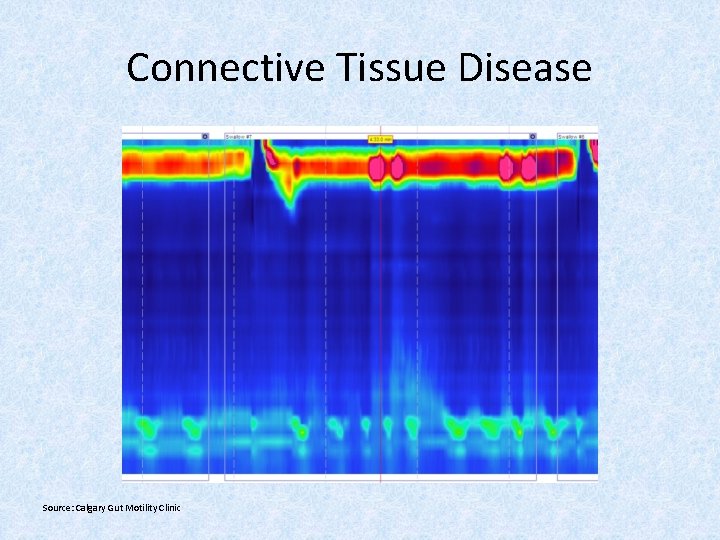 Connective Tissue Disease Source: Calgary Gut Motility Clinic 