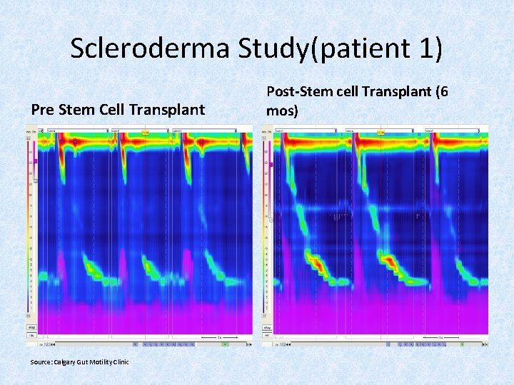 Scleroderma Study(patient 1) Pre Stem Cell Transplant Source: Calgary Gut Motility Clinic Post-Stem cell