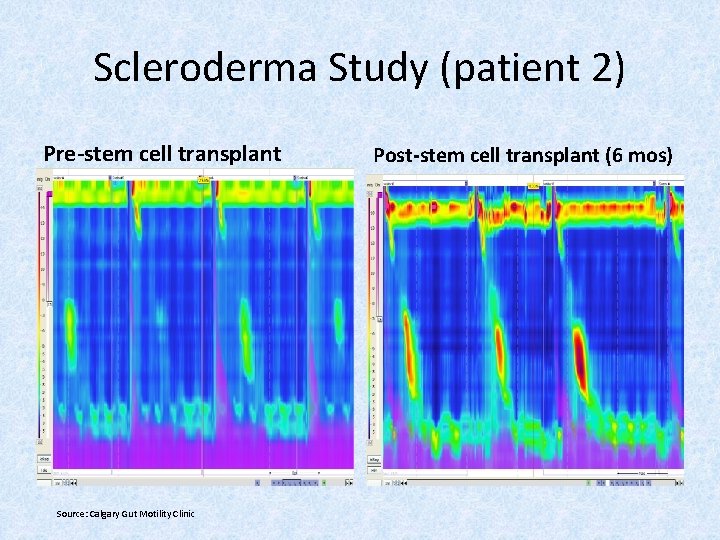 Scleroderma Study (patient 2) Pre-stem cell transplant Source: Calgary Gut Motility Clinic Post-stem cell