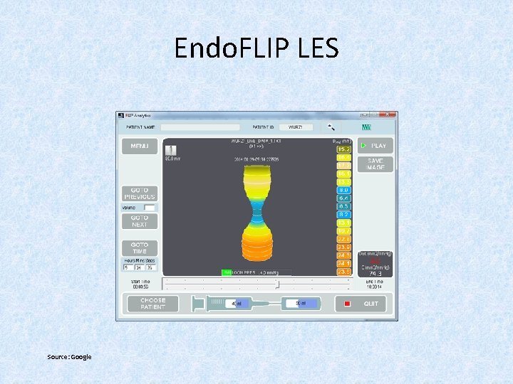 Endo. FLIP LES Source: Google 