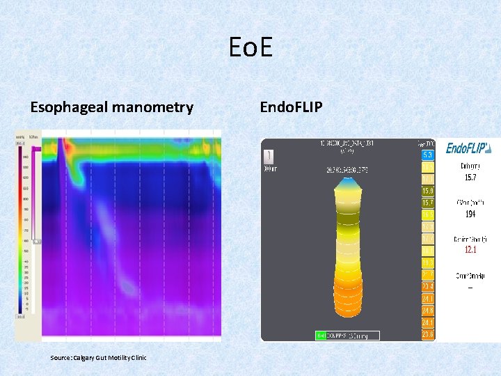 Eo. E Esophageal manometry Source: Calgary Gut Motility Clinic Endo. FLIP 