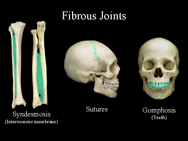 Fibrous Joints Syndesmosis (Interosseous membrane) Sutures Gomphosis (Teeth) 