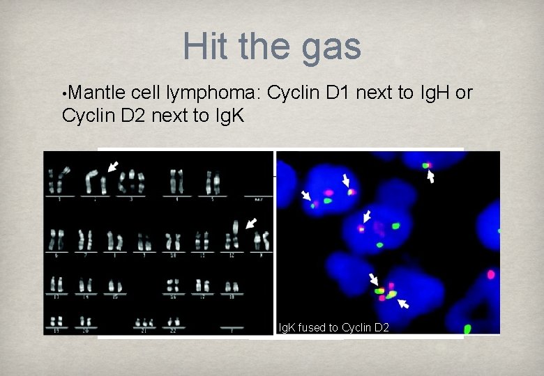Hit the gas • Mantle cell lymphoma: Cyclin D 1 next to Ig. H